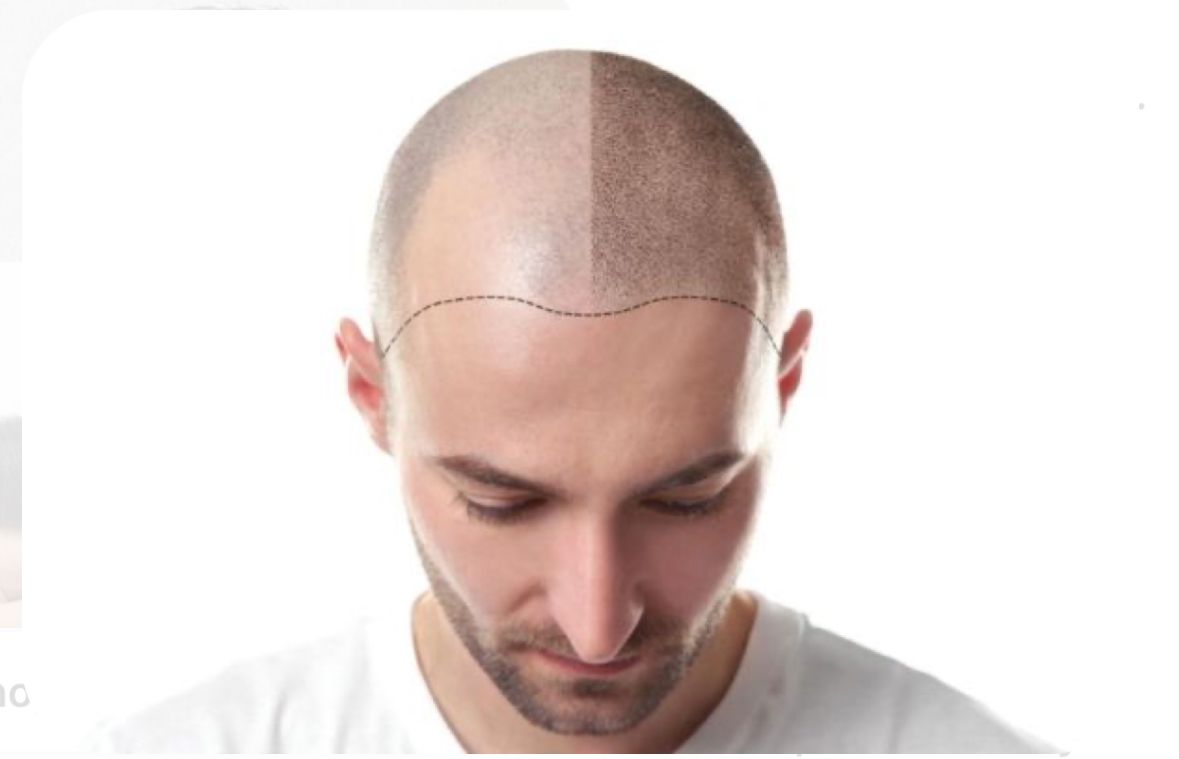 SCALP TATTOOING