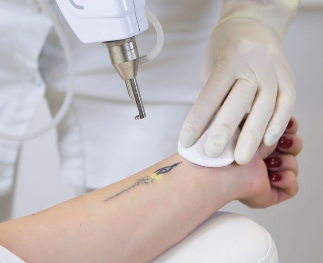TATTOO / PERMANENT MAKEUP REMOVAL