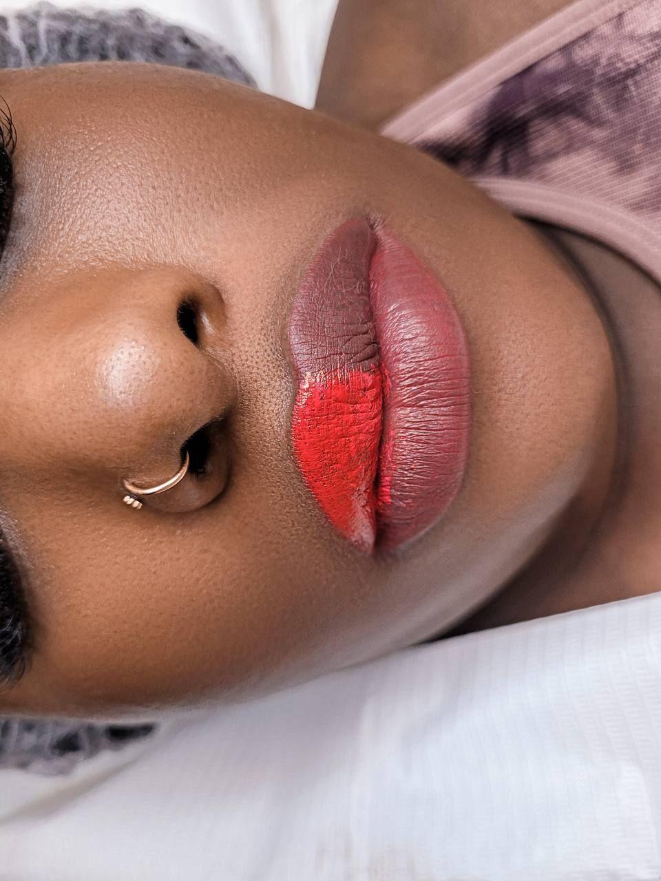 Dark Lip Neutralization: Process, Healing, and Results